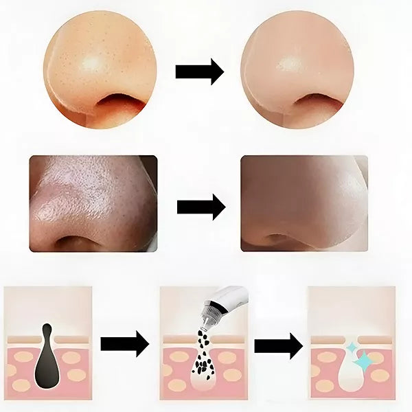 Porų valymo ir mikrodermabrazijos prietaisas „2-viename“ – švari ir švytinti oda be pastangų